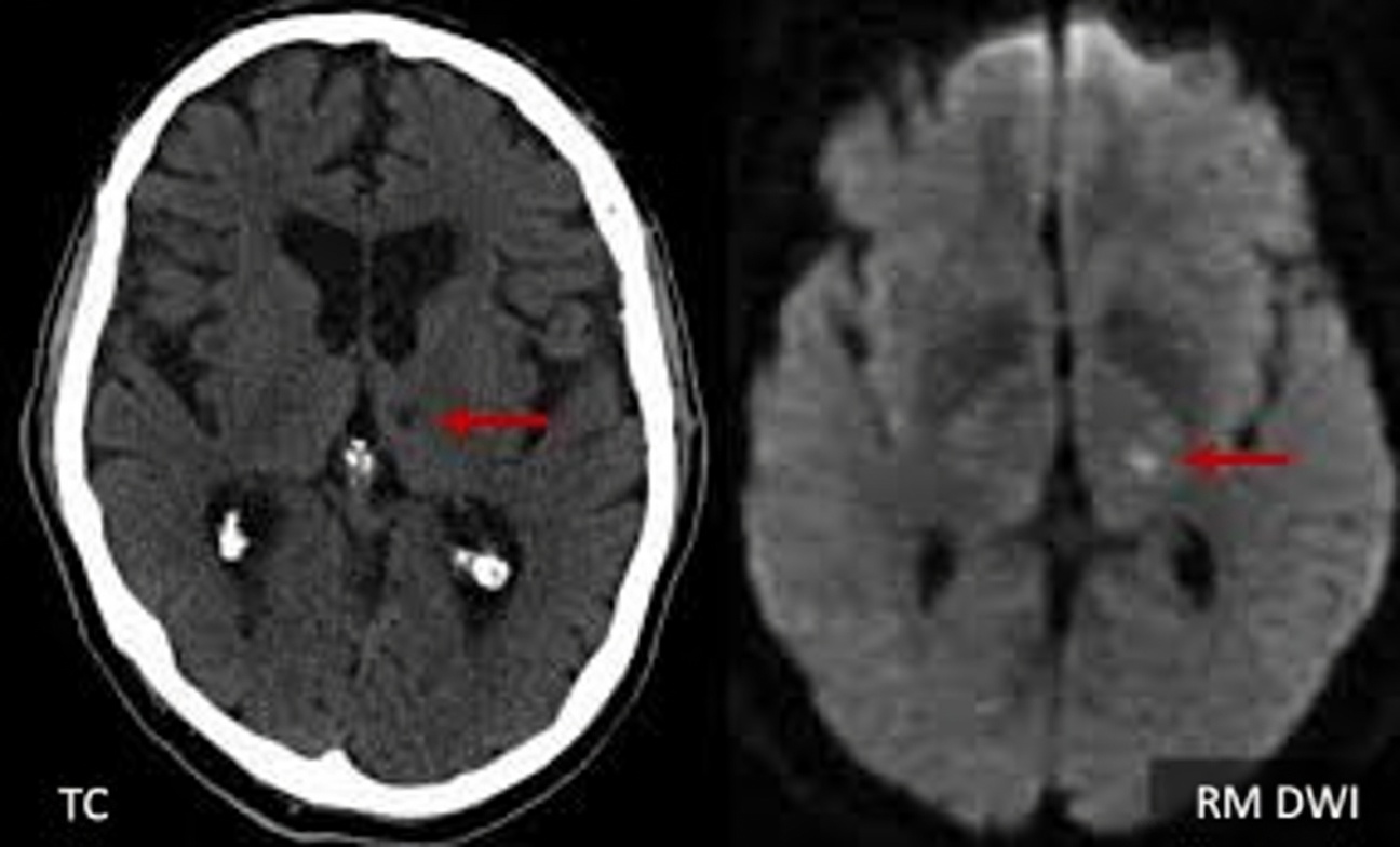 7 Sinais de Alerta de AVC Lacunar que Passam Despercebidos em Pessoas com Mais de 60 Anos (A Maioria das Pessoas Não Percebe o Nº 4)