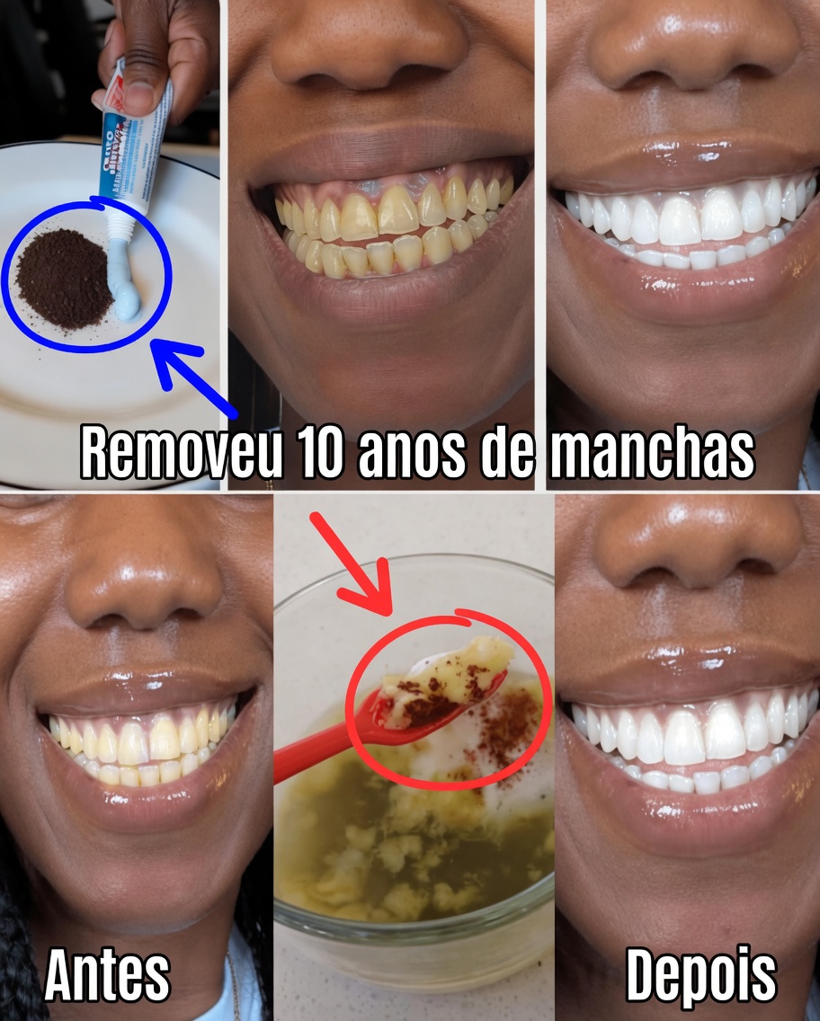 Em apenas 2 minutos, remova 10 anos de manchas nos dentes – o clareador natural que realmente funciona
