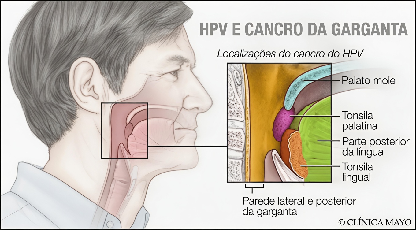 Quais são os sintomas comuns do HPV na garganta? Principais sinais que você precisa conhecer