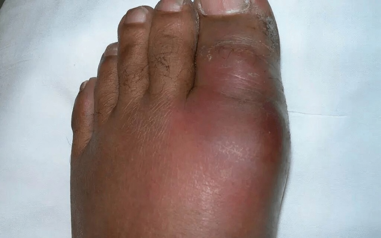 11 Alimentos Comprovados por Pesquisas que Podem Ajudar a Reduzir Naturalmente Seus Níveis de Ácido Úrico