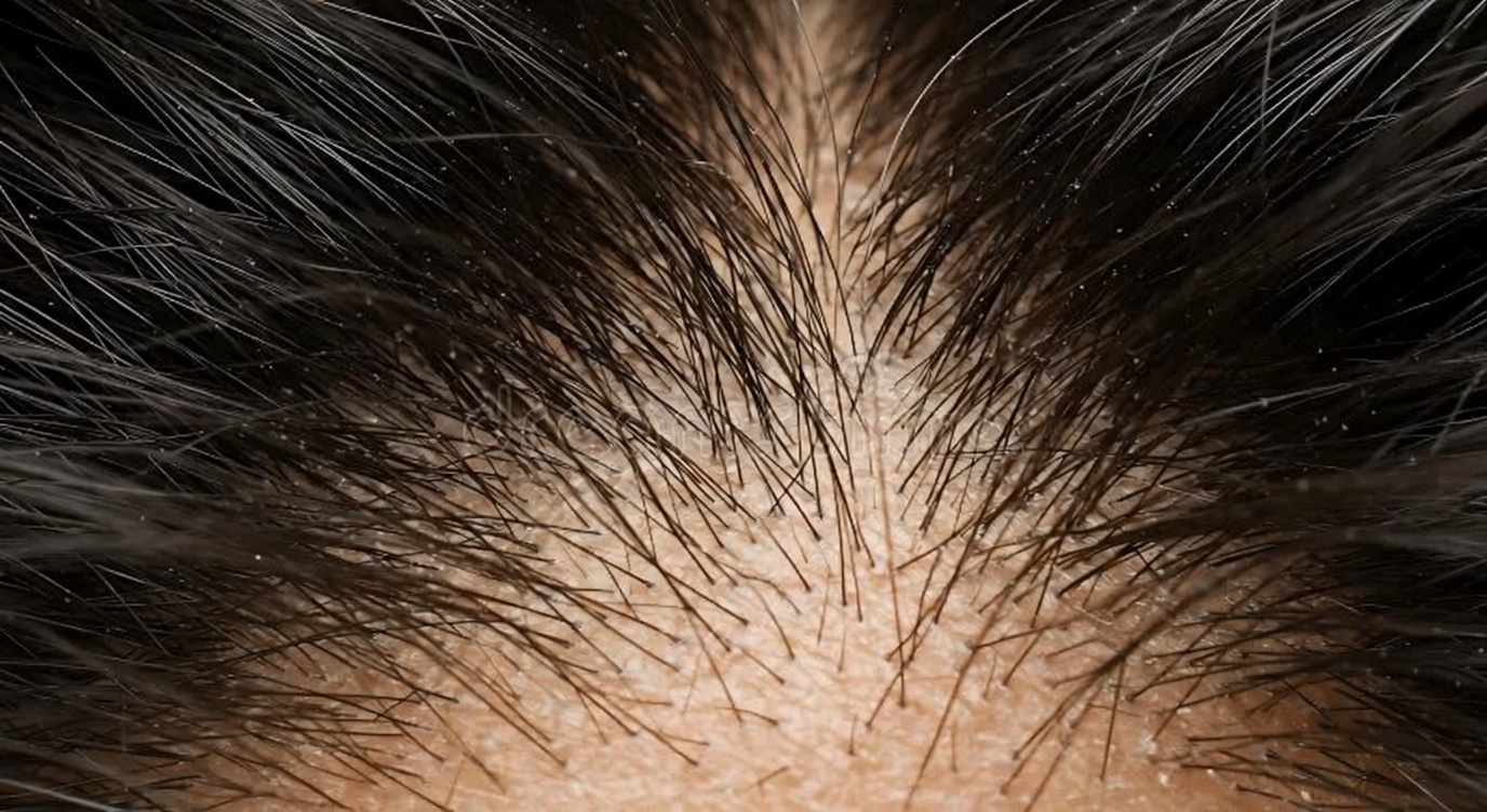 Use Isto Duas Vezes por Semana e Veja um Potencial Crescimento Mais Rápido do Cabelo – O Poder do Gengibre para a Saúde do Couro Cabeludo e Fios Mais Cheios