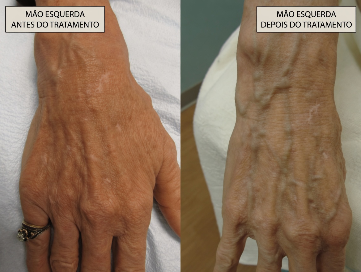 Se você tem veias visíveis nos braços ou nas pernas: o que isso pode realmente significar