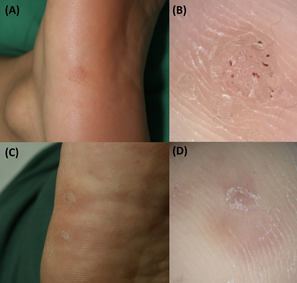 A Casca de Banana Pode Realmente Ajudar com Verrugas? Um Olhar Gentil Sobre Este Simples Remédio Caseiro
