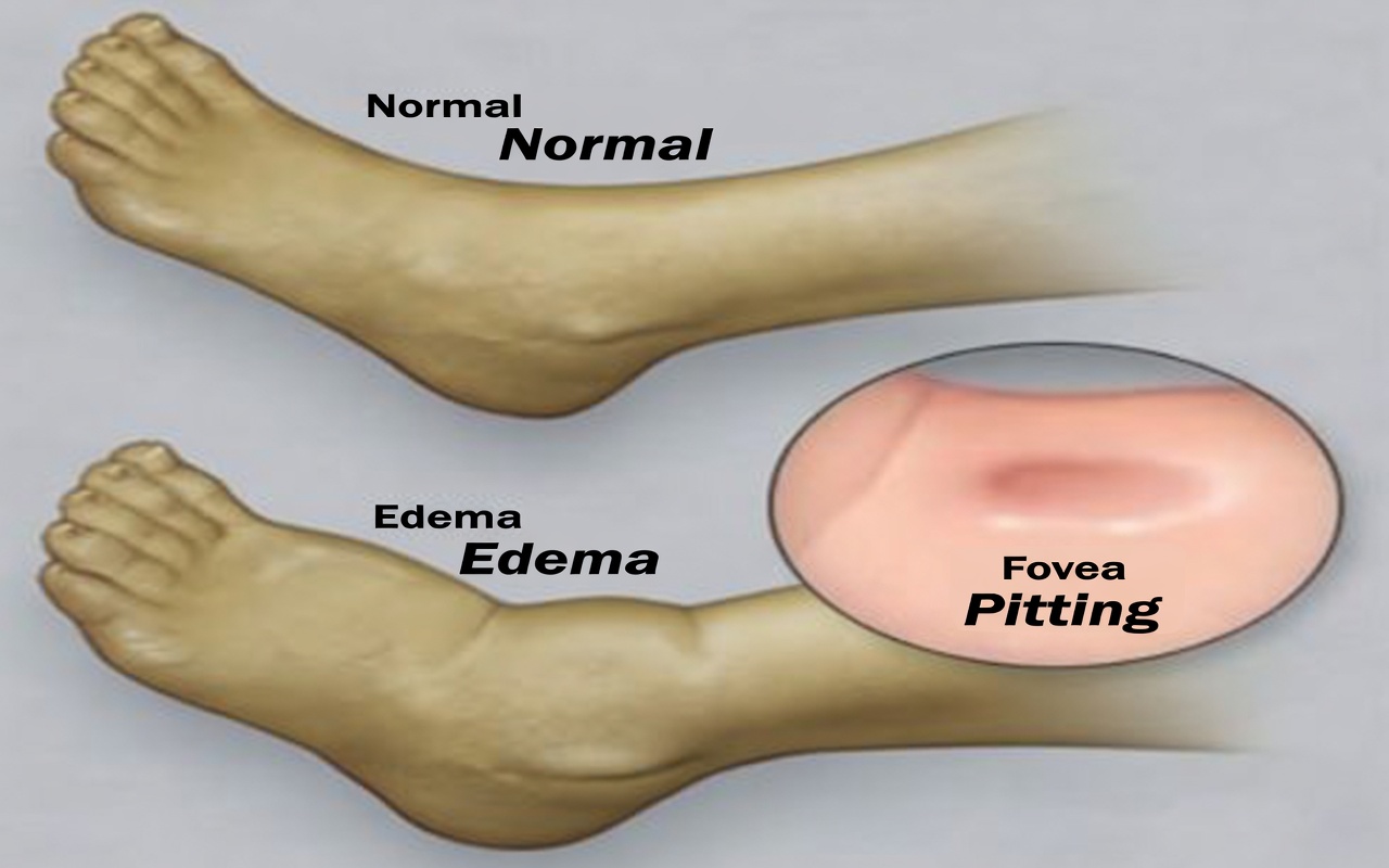 Como Seus Pés Estão Avisando Sobre Problemas no Fígado: Não Ignore Esses Sinais Sutis