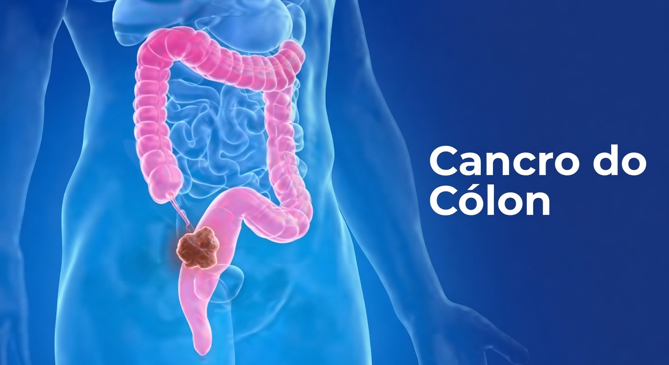 Como o gengibre atinge células-tronco cancerígenas de próstata, ovário e cólon melhor do que a quimioterapia