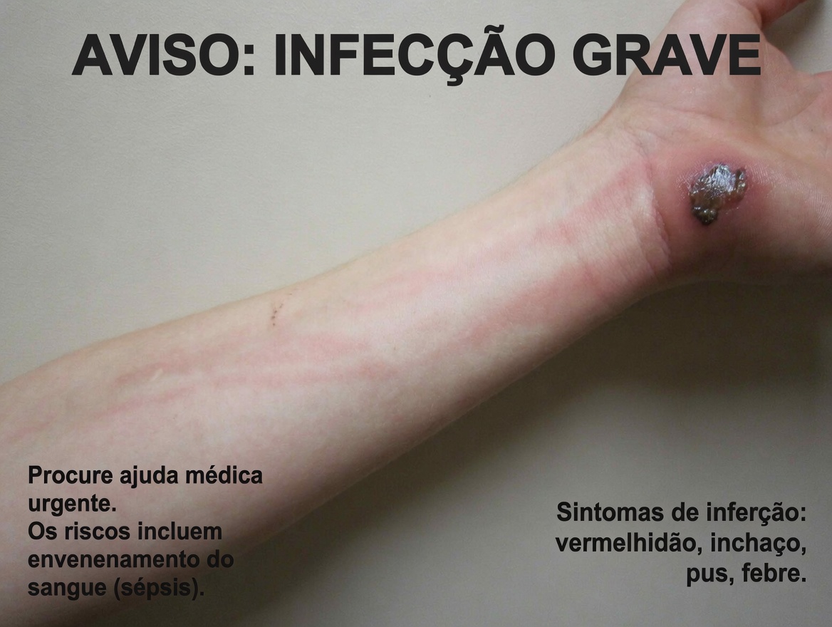 Ferida dolorosa com centro escuro na panturrilha: um alerta na pele que você não deve ignorar