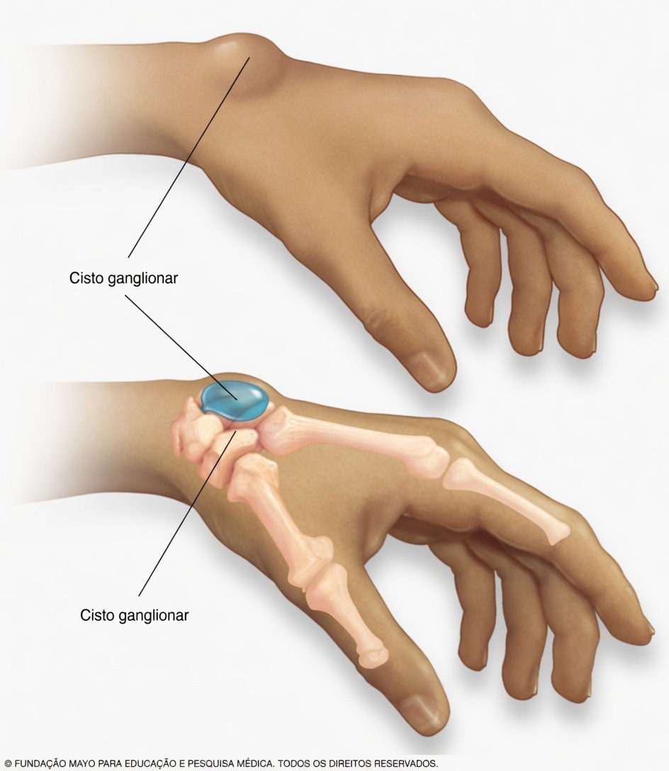 Um Caroço Estranho no Pulso da Noite para o Dia? O Que Pessoas Idosas Devem Saber