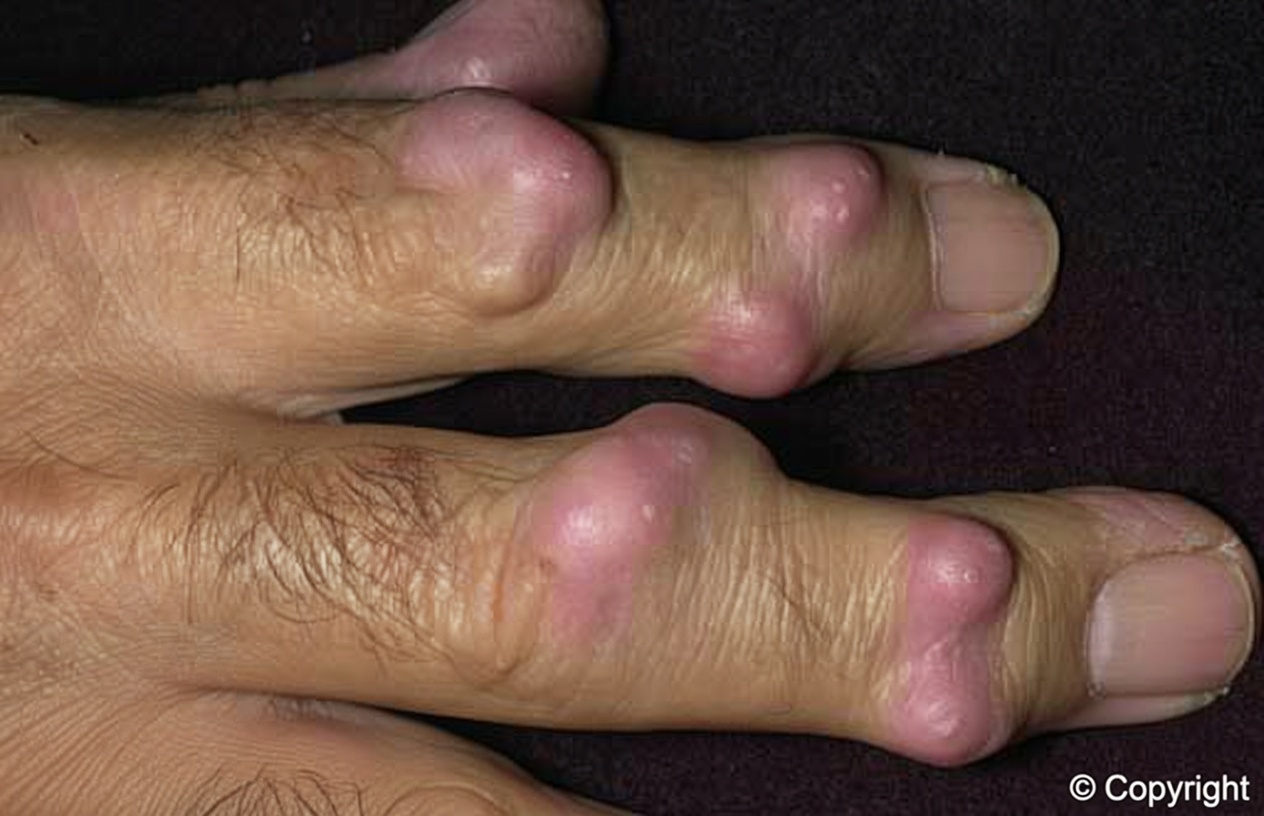 Um Caroço Estranho no Pulso da Noite para o Dia? O Que Pessoas Idosas Devem Saber