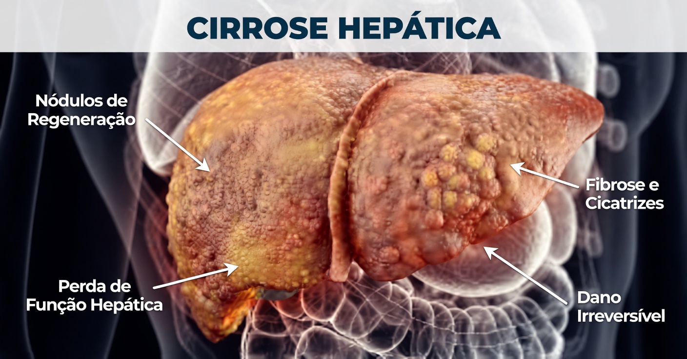 REVELADO! Este alimento DESTRÓI o seu FÍGADO (e você não faz ideia)! O inimigo nº 1 do fígado gorduroso
