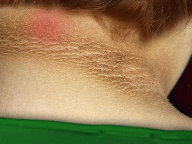 15 Sinais Precoces de Alerta de Diabetes que Você Deve Reconhecer para Melhor Consciência sobre a Saúde