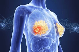 6 Sinais Sutis de Câncer de Mama que as Pessoas Tendem a Ignorar