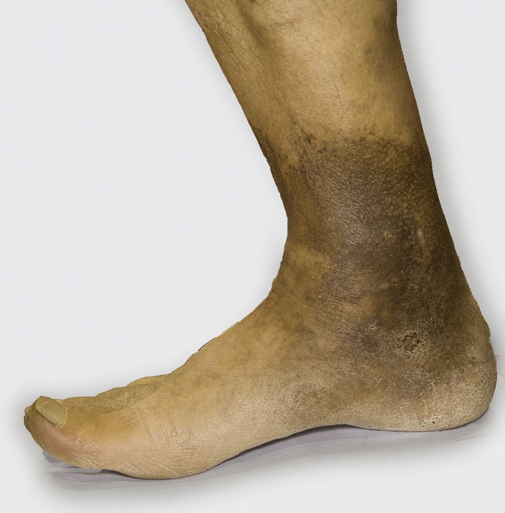 7 Sinais de Alerta de Artérias Obstruídas nas Pernas e nos Pés – Não Ignore Estes Sinais Silenciosos