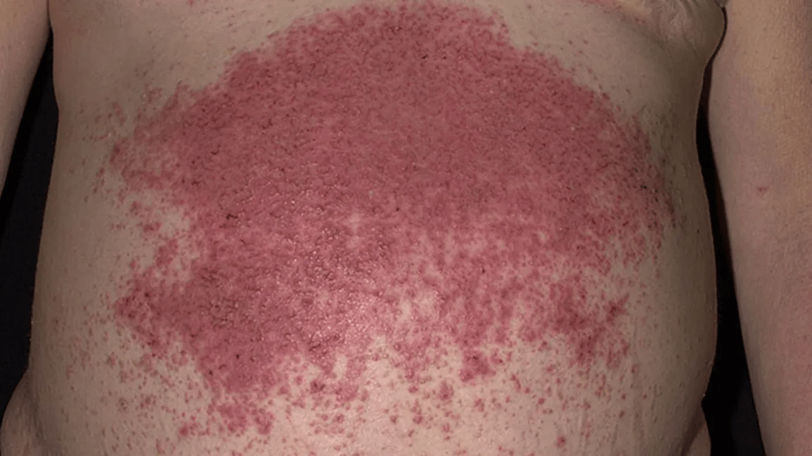 O que fazer se a mãe tiver uma erupção cutânea com bolhas envolvendo a lateral do corpo: dicas de conforto em casa enquanto espera pelo pronto-socorro