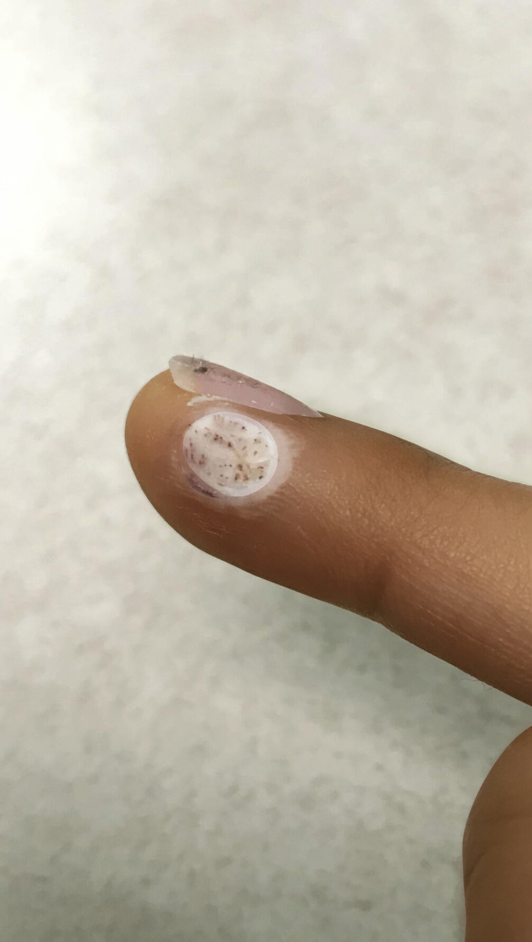 O peróxido de hidrogênio pode ajudar com verrugas? Usos práticos, dicas de segurança e o que esperar em casa