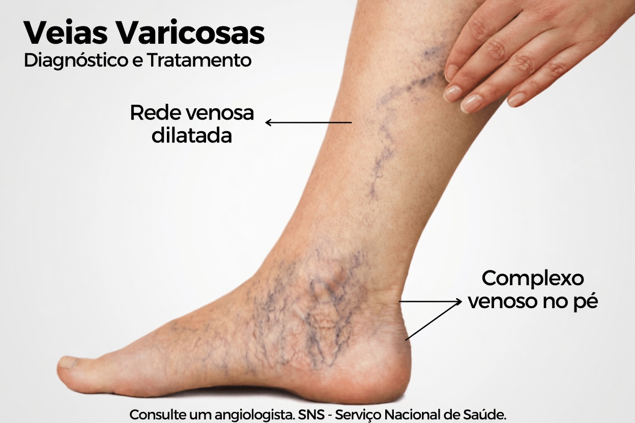 10 Hábitos Naturais de Estilo de Vida para Apoiar a Circulação nas Pernas e Aliviar o Desconforto das Varizes