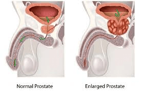 Por que pular exames regulares da próstata pode aumentar o risco de câncer de próstata em homens acima dos 40 anos