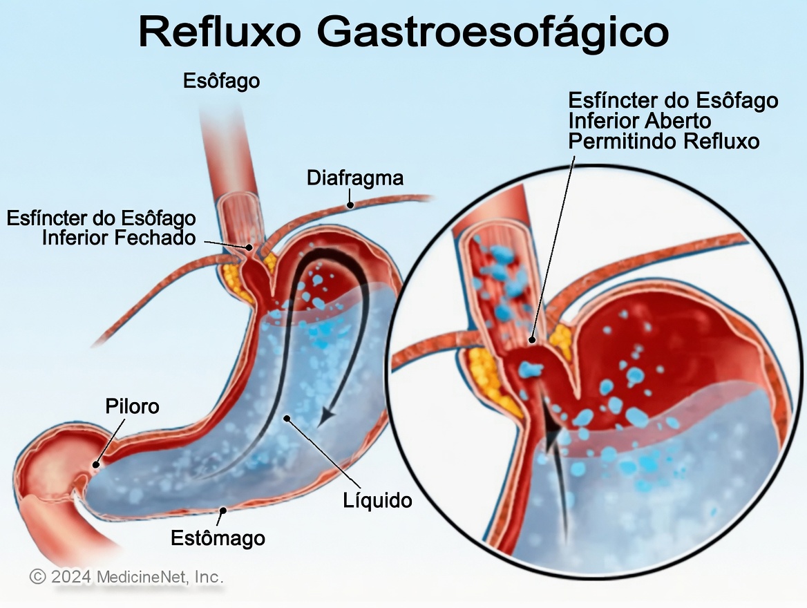 10 Sinais e Sintomas de Hérnia de Hiato que Você Deve Conhecer para Melhor Consciência Digestiva