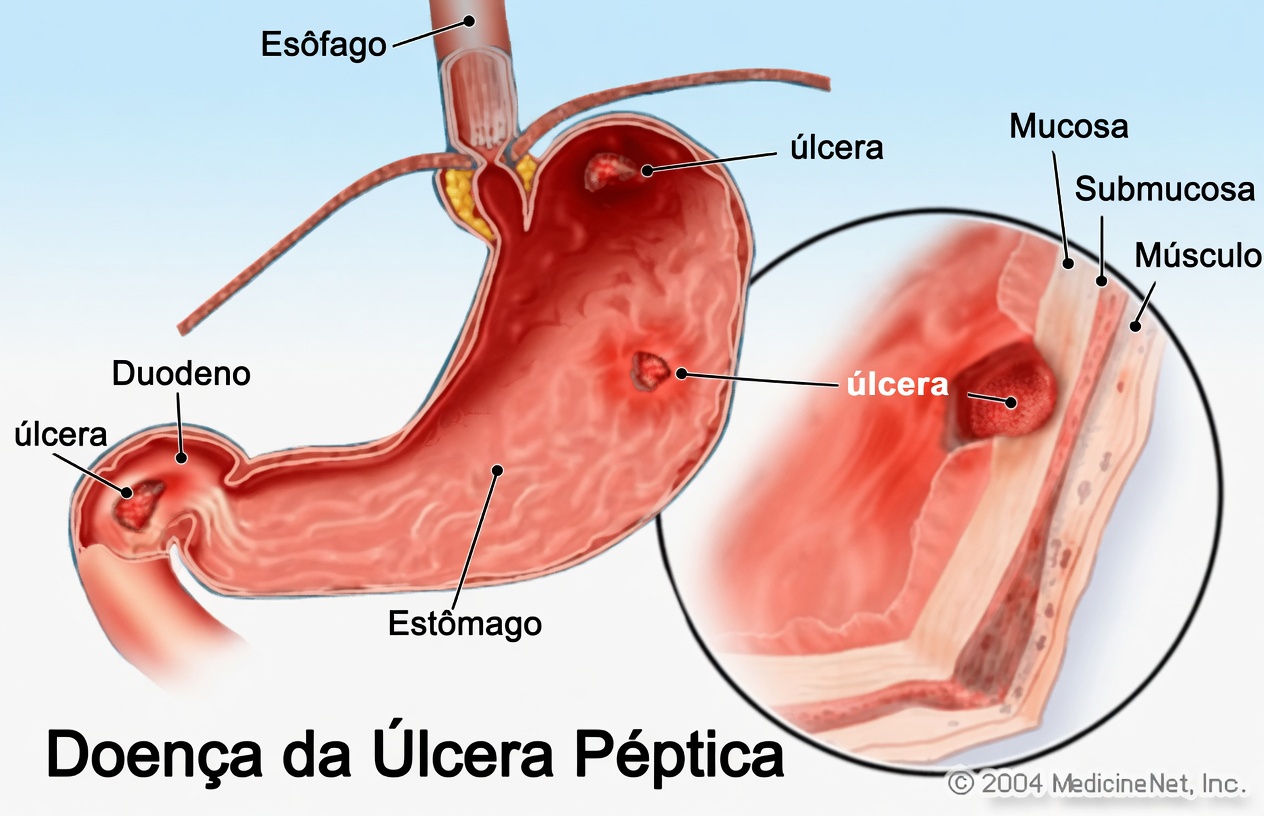 Por que sua úlcera pode não melhorar: hábitos alimentares do dia a dia que podem retardar a cicatrização do estômago