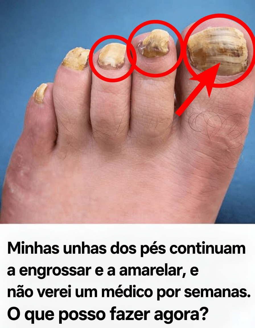 Unhas dos pés grossas e amareladas piorando: o que você pode fazer com segurança agora mesmo em casa