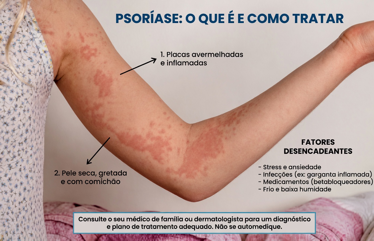 Por que a urticária aparece na sua pele? Descubra os gatilhos diários surpreendentes e os padrões ocultos por trás da coceira