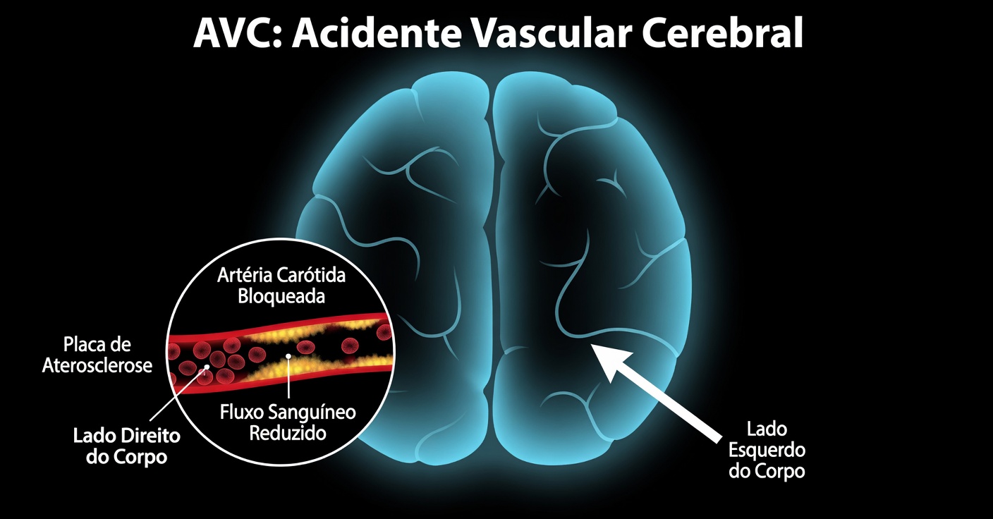 9 Sinais de Alerta de Artérias Carótidas Obstruídas que Você Nunca Deve Ignorar (Especialmente o nº 5)