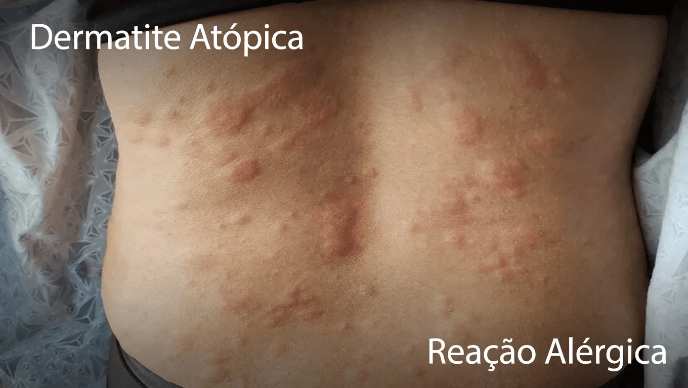 Gatilhos Inesperados de Urticária que Você Talvez Não Conheça — E o que Fazer a Seguir