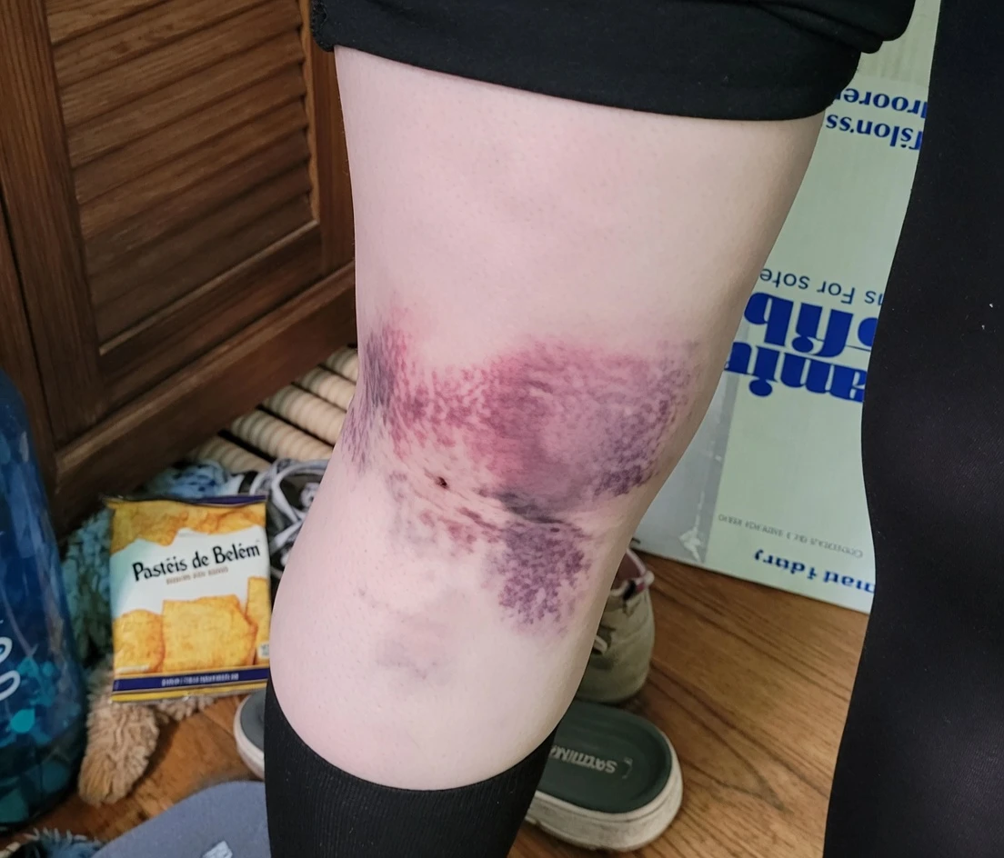 10 Sinais Sutis de Alerta do Câncer de Pâncreas que Você Não Deve Ignorar